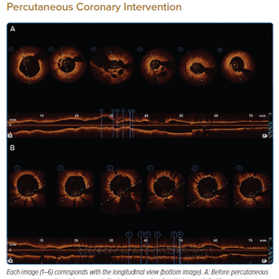 Case 2 – Optical Coherence Tomography Evaluation Before and After Percutaneous Coronary Intervention