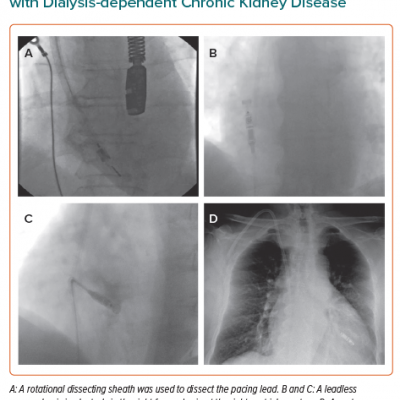 Extraction of a Pacemaker in a Patient with Dialysis-dependent Chronic Kidney Disease