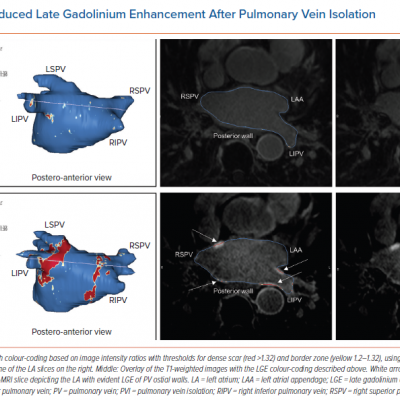 Ablation-induced Late Gadolinium Enhancement After Pulmonary Vein Isolation
