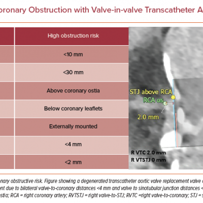 CT Predictors for Coronary Obstruction with Valve-in-valve Transcatheter Aortic Valve Replacement