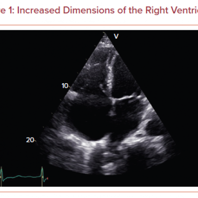 Increased Dimensions of the Right Ventricle