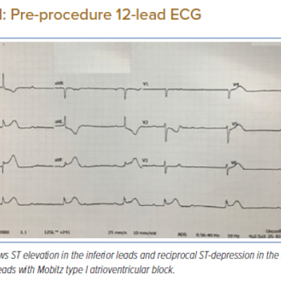 Pre-procedure 12-lead ECG