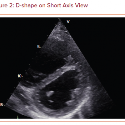 D-shape on Short Axis View