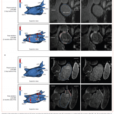 Gaps in Ablation Lesions After Pulmonary Vein Isolation