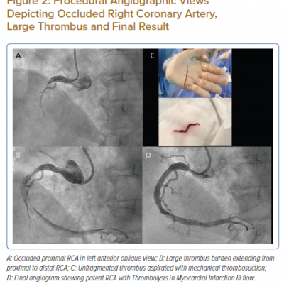 Procedural Angiographic Views Depicting Occluded Right Coronary Artery Large Thrombus and Final Result