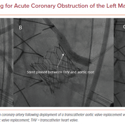 Rescue Snorkel Stenting for Acute Coronary Obstruction of the Left Main Coronary Artery
