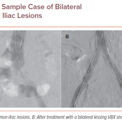 Sample Case of Bilateral Common Iliac Lesions