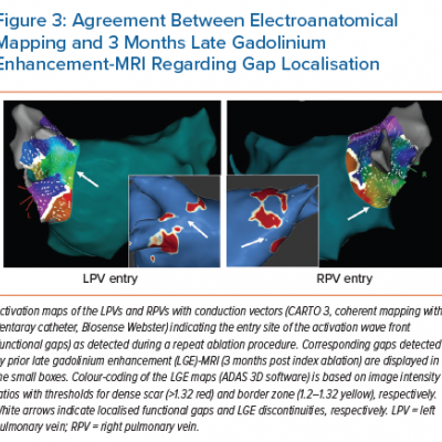 Agreement Between Electroanatomical Mapping and 3 Months Late Gadolinium Enhancement-MRI Regarding Gap Localisation