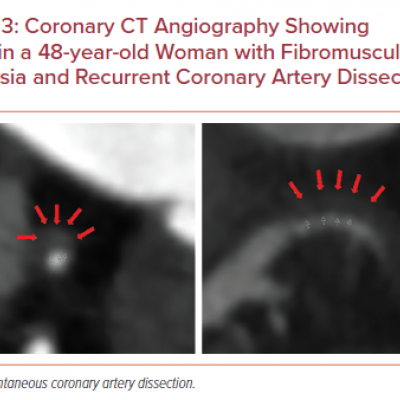 Coronary CT Angiography Showing SCAD in a 48-year-old Woman with Fibromuscular Dysplasia and Recurrent Coronary Artery Dissection
