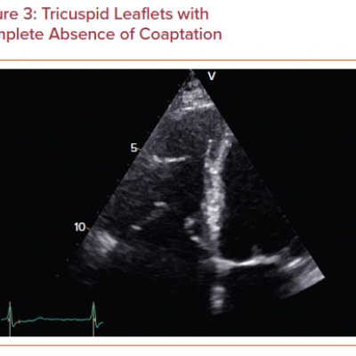 Tricuspid Leaflets with Complete Absence of Coaptation