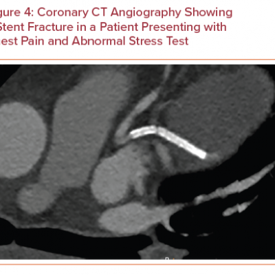 Coronary CT Angiography Showing a Stent Fracture in a Patient Presenting with Chest Pain and Abnormal Stress Test