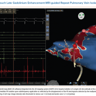 Single-touch Late Gadolinium Enhancement-MRI-guided Repeat Pulmonary Vein Isolation