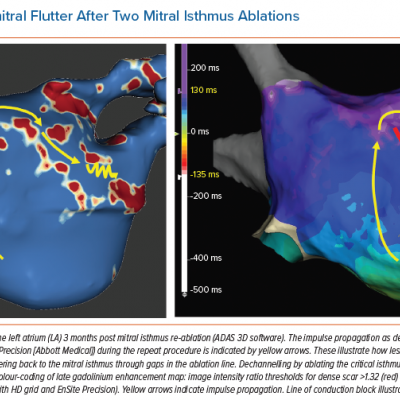 Recurrent Perimitral Flutter After Two Mitral Isthmus Ablations