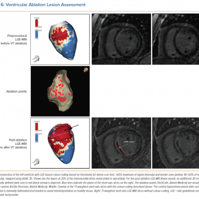 Ventricular Ablation Lesion Assessment