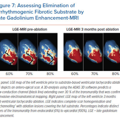 Assessing Elimination of Arrhythmogenic Fibrotic Substrate by Late Gadolinium Enhancement-MRI