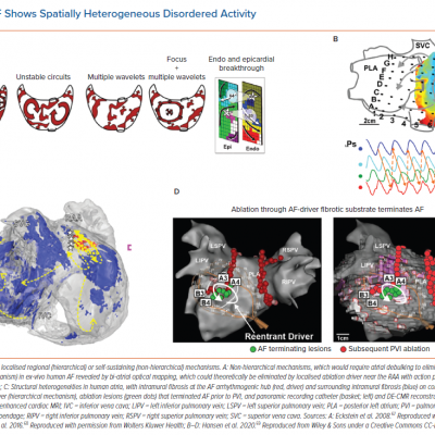 AF Shows Spatially Heterogeneous Disordered Activity