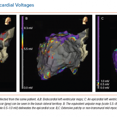 Endocardial and Epicardial Voltages
