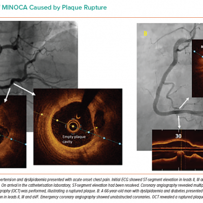 Examples of MINOCA Caused by Plaque Rupture 