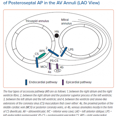 Schematic Diagram of the Four Subtypes of Posteroseptal AP in the AV Annuli LAO View