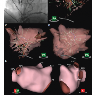 Ultrasound Generation of Atrial Anatomy