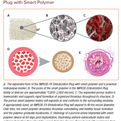 IMPEDE-FX Embolization Plug with Smart Polymer