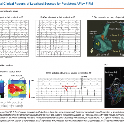 Initial Clinical Reports of Localised Sources for Persistent AF by FIRM