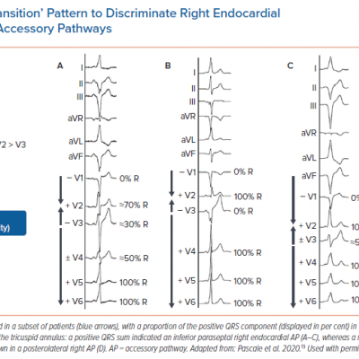 The ‘Double Transition’ Pattern to Discriminate Right Endocardial Posterior/Posteroseptal Accessory Pathways