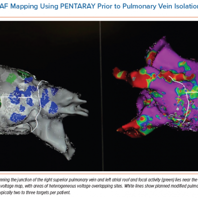 CARTOFINDER AF Mapping Using PENTARAY Prior to Pulmonary Vein Isolation