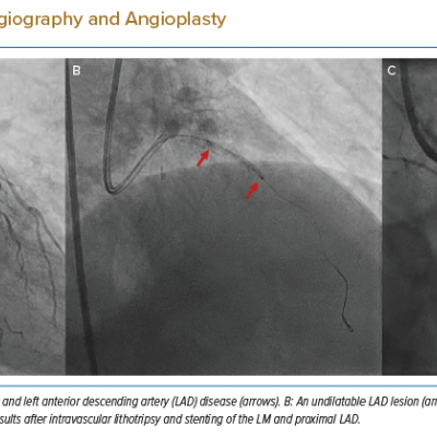 Case 2, Coronary Angiography and Angioplasty