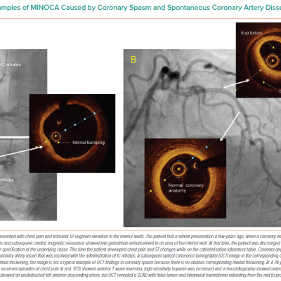 Examples of MINOCA Caused by Coronary Spasm and Spontaneous Coronary Artery Dissection