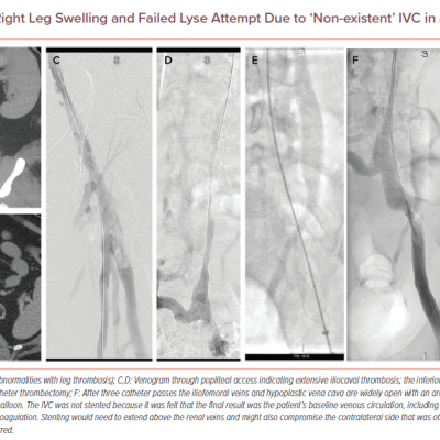 Persistent Right Leg Swelling and Failed Lyse Attempt Due to ‘Non-existent’ IVC in a 42-year-old Man