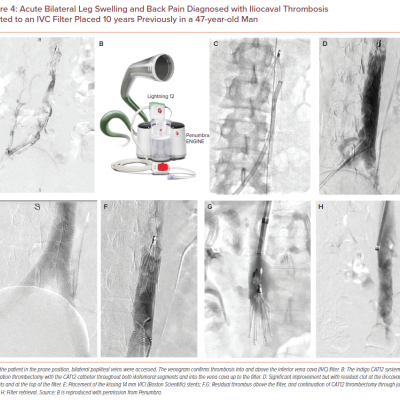 Acute Bilateral Leg Swelling and Back Pain Diagnosed with Iliocaval Thrombosis Related to an IVC Filter Placed 10 years Previously in a 47-year-old Man