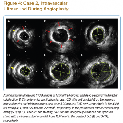 Case 2 Intravascular Ultrasound During Angioplasty