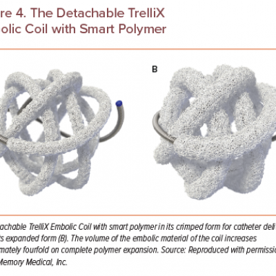 The Detachable TrelliX Embolic Coil with Smart Polymer