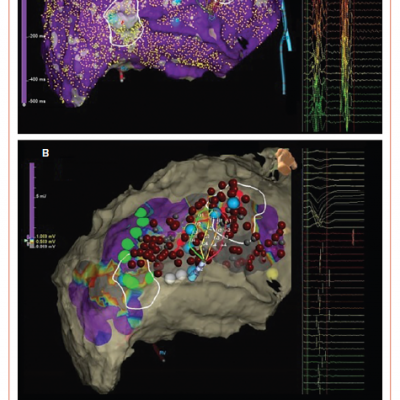 Ablation of Late Potentials