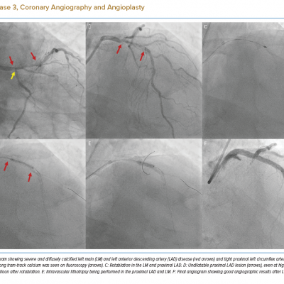 Case 3, Coronary Angiography and Angioplasty
