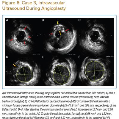 Case 3 Intravascular Ultrasound During Angioplasty