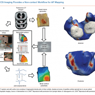 ECG Imaging Provides a Non-contact Workflow for AF Mapping