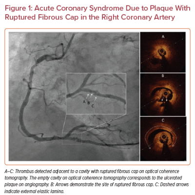 Acute Coronary Syndrome Due to Plaque With Ruptured Fibrous Cap in the Right Coronary Artery