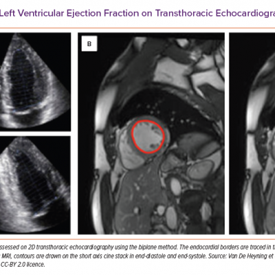 Assessment of Left Ventricular Ejection Fraction on Transthoracic Echocardiography and Cardiac MRI