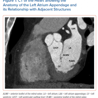 CT of the Heart Showing the Anatomy of the Left Atrium Appendage and its Relationship with Adjacent Structures