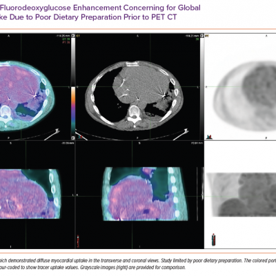 Diffuse Fluorodeoxyglucose Enhancement Concerning for Global Myocardial Uptake Due to Poor Dietary Preparation Prior to PET CT