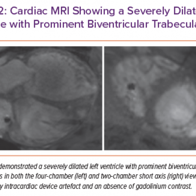 Cardiac MRI Showing a Severely Dilated Left Ventricle with Prominent Biventricular Trabeculations