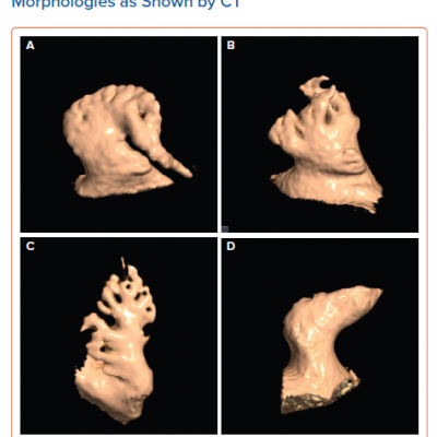 Four Different Left Atrium Appendage Morphologies as Shown by CT