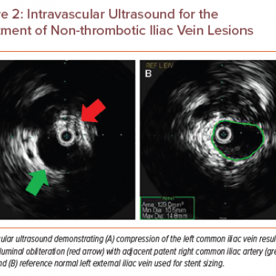 Intravascular Ultrasound for the Treatment of Non-thrombotic Iliac Vein Lesions