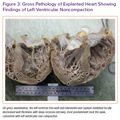 Gross Pathology of Explanted Heart Showing Findings of Left Ventricular Noncompaction