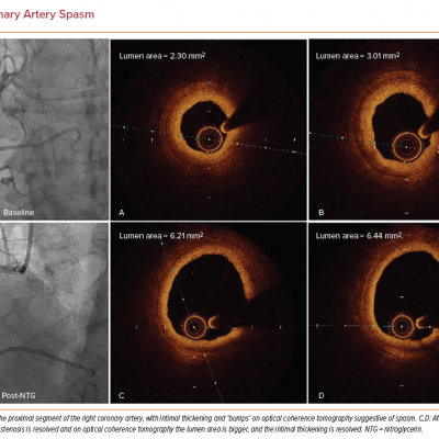 Coronary Artery Spasm
