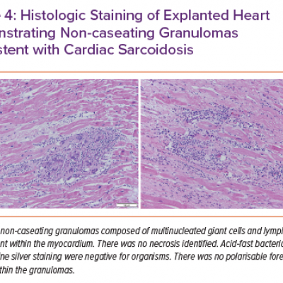 Histologic Staining of Explanted Heart Demonstrating Non-caseating Granulomas Consistent with Cardiac Sarcoidosis