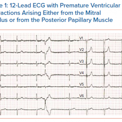 12-Lead ECG with Premature Ventricular Contractions Arising Either from the Mitral Annulus or from the Posterior Papillary Muscle