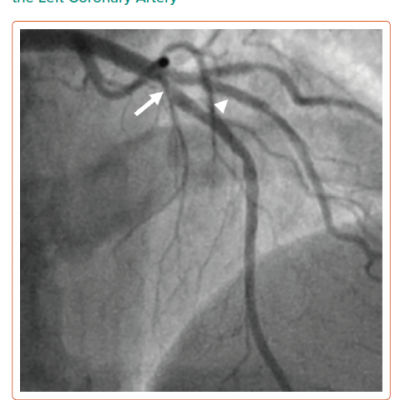 Coronary Angiography of the Left Coronary Artery